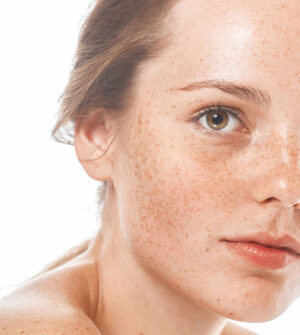 Pigmentvlekken op het Gezicht