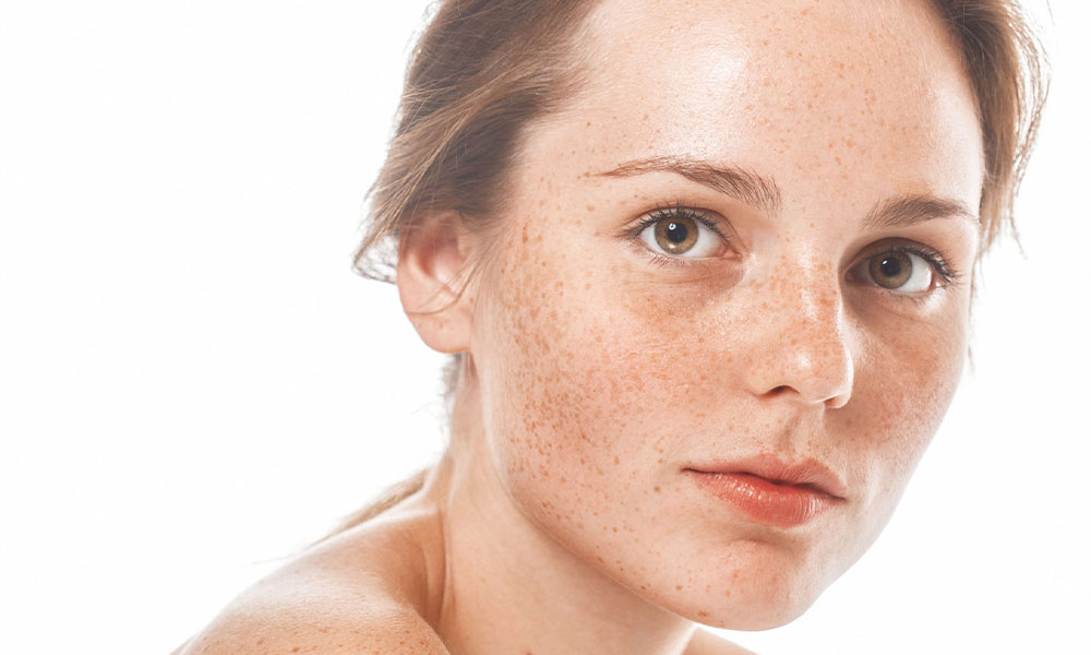 Pigmentvlekken op het Gezicht