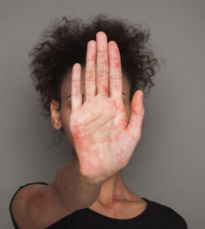 Pigmentvlekken op het Handen