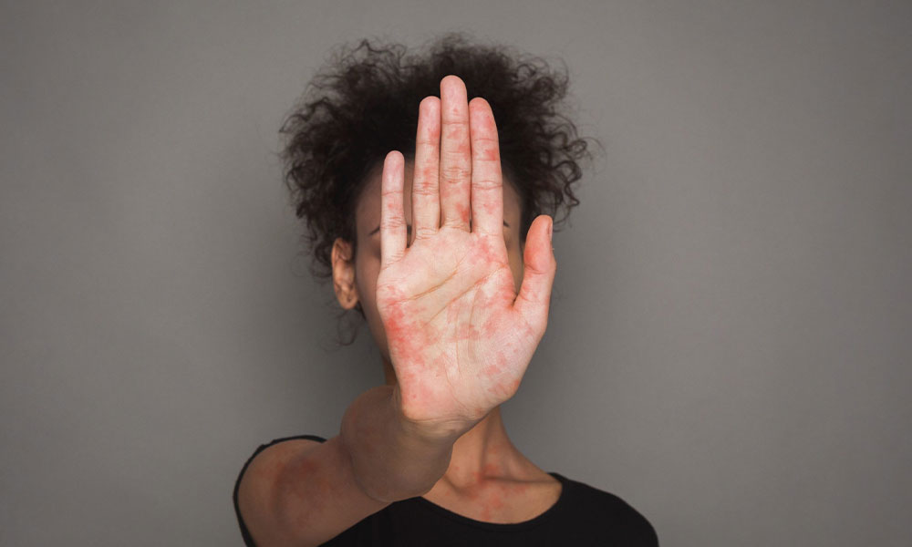 Pigmentvlekken op het Handen