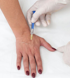 Radiesse Handen Fillers