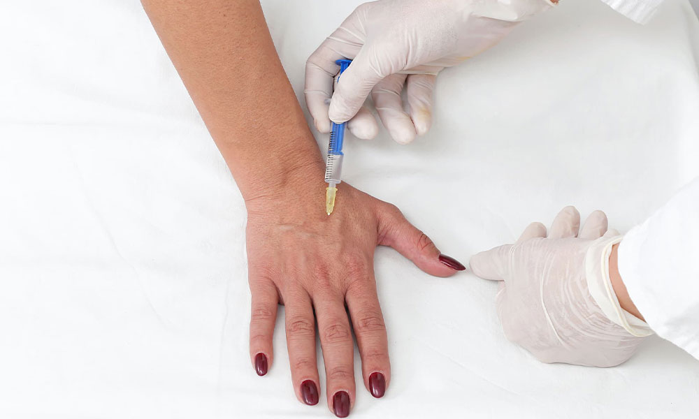 Radiesse Handen Fillers
