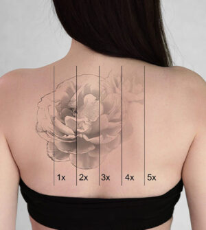 Tattoo Verwijderen