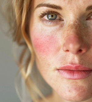 Wangen Couperose en Rosacea Behandeling