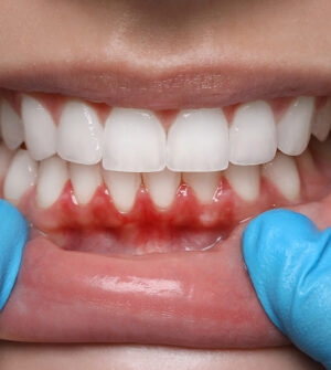 Behandeling van Tandvleesontsteking (Gingivitis)