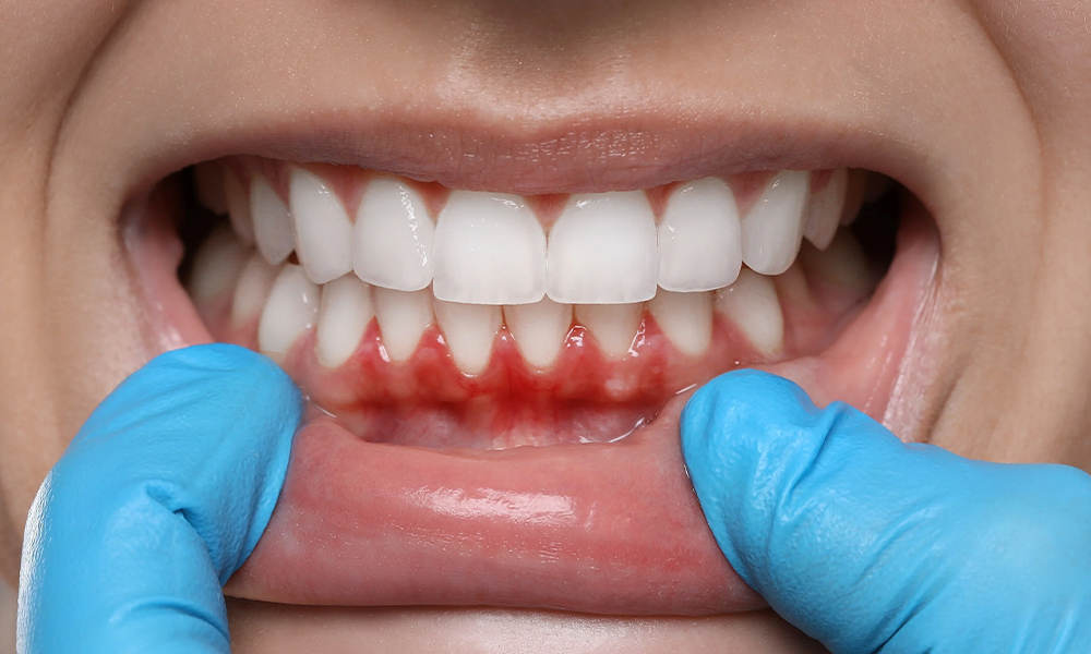 Behandeling van Tandvleesontsteking (Gingivitis)