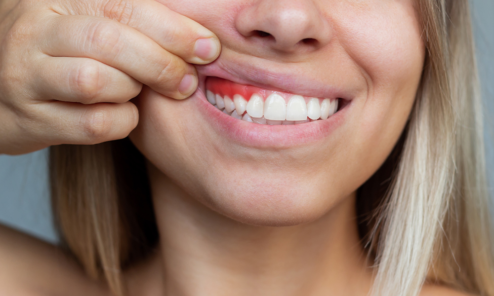 Behandeling van Tandvleesrecessie