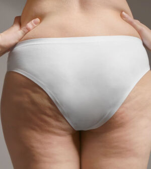 Cellulite en Striae (Huidstriemen)