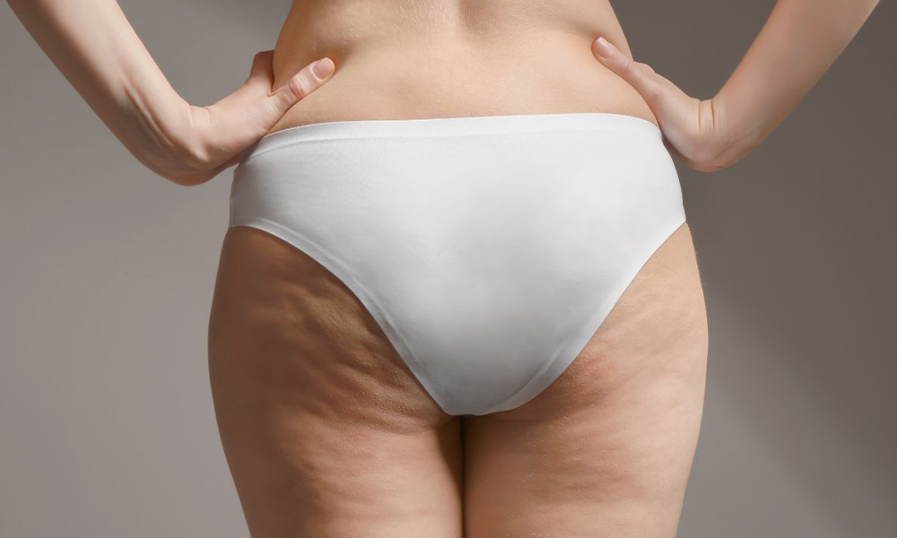 Cellulite en Striae (Huidstriemen)