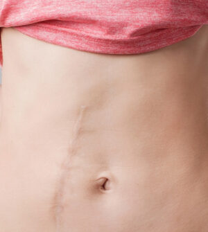 Chirurgische Littekens