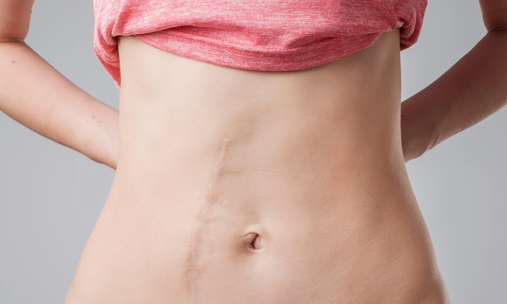 Chirurgische Littekens