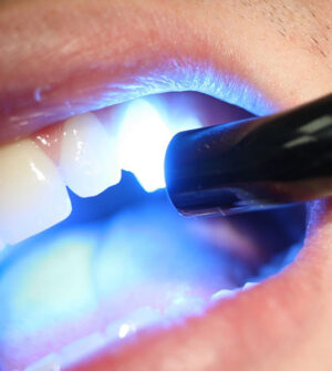 Composietvullingen (Witte of Esthetische Vullingen)