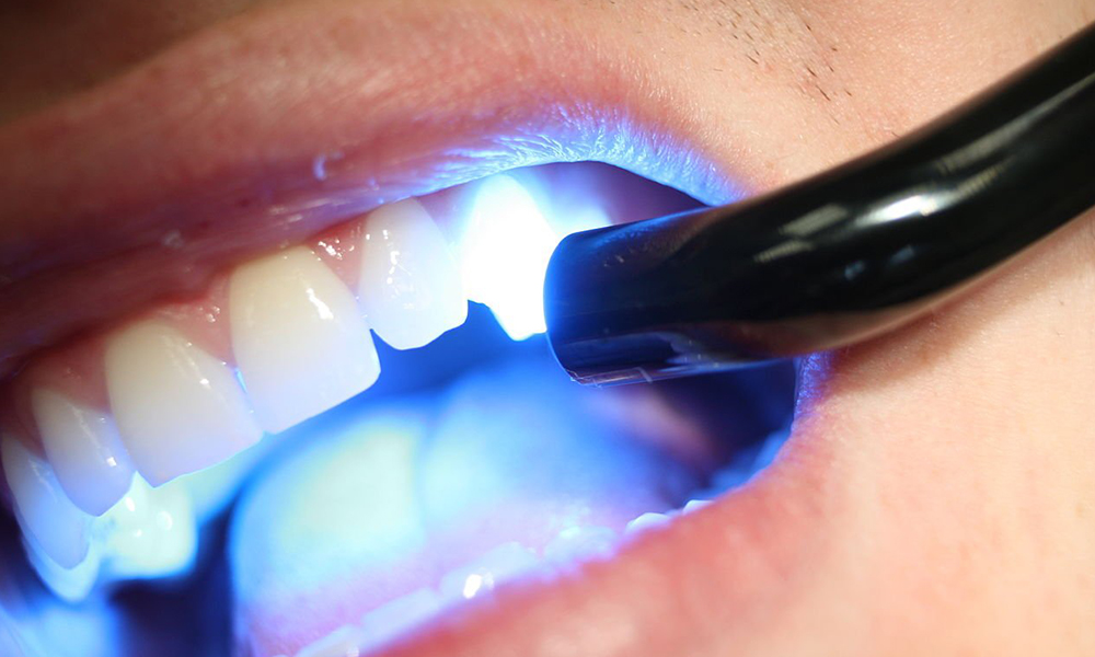 Composietvullingen (Witte of Esthetische Vullingen)