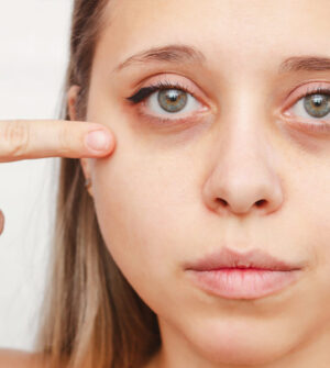 Donkere Kringen Onder De Ogen