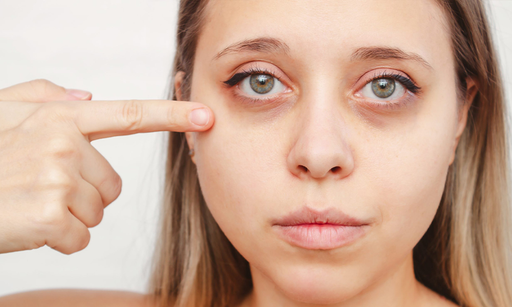 Donkere Kringen Onder De Ogen