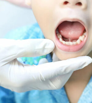 Frenectomie (Tongriem - of Lipriemoperatie)