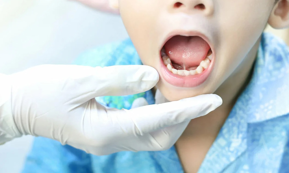 Frenectomie (Tongriem – of Lipriemoperatie)