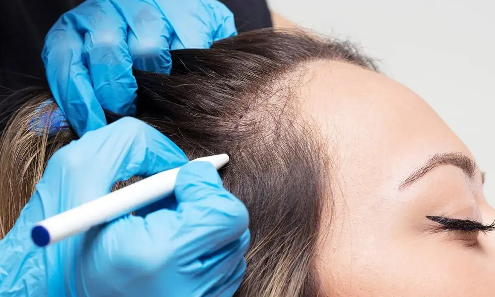 Haartransplantatie bij Vrouwen