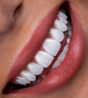 Hollywood Smile (Glimlachesthetiek)