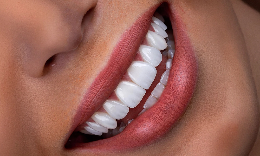 Hollywood Smile (Glimlachesthetiek)