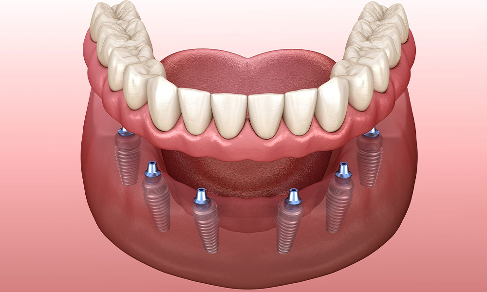 Implantaatgedragen Prothese