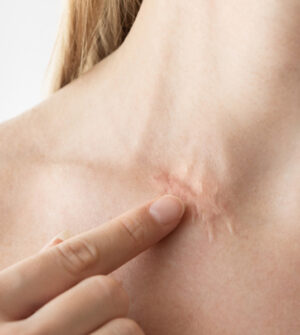 Littekens en Huidbeschadigingen