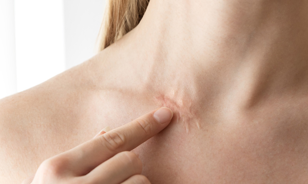 Littekens en Huidbeschadigingen