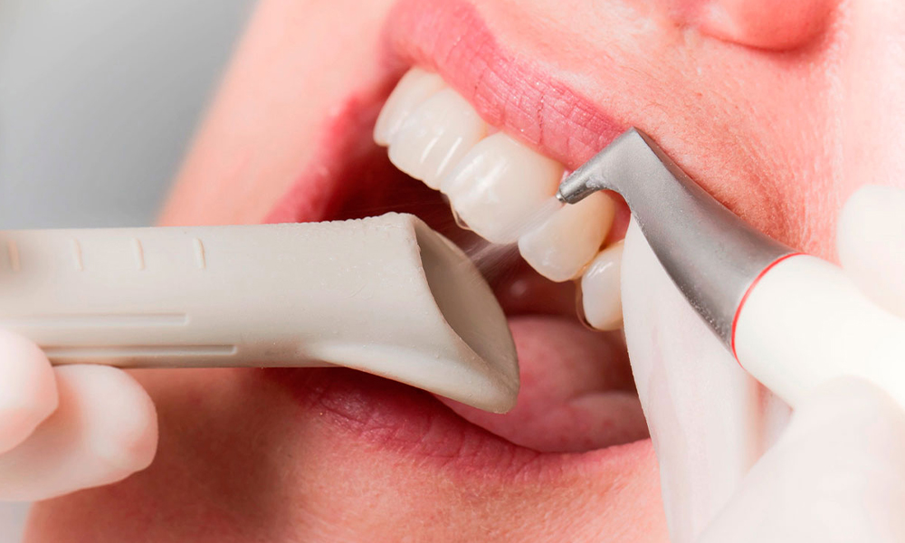 Tandreiniging met Airflow