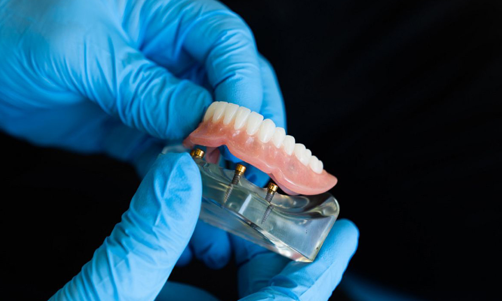 Vaste Prothese (Kronen en Bruggen)