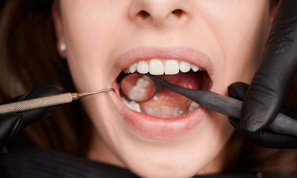 Verwijderen van een Verstandskies