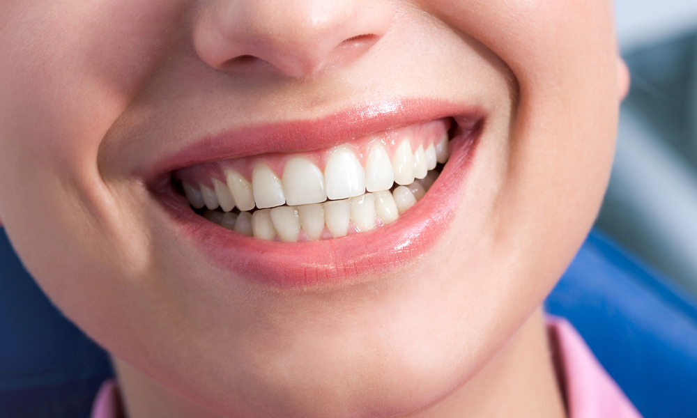 Wortelkanaalbehandeling van een Enkelwortelige Tand