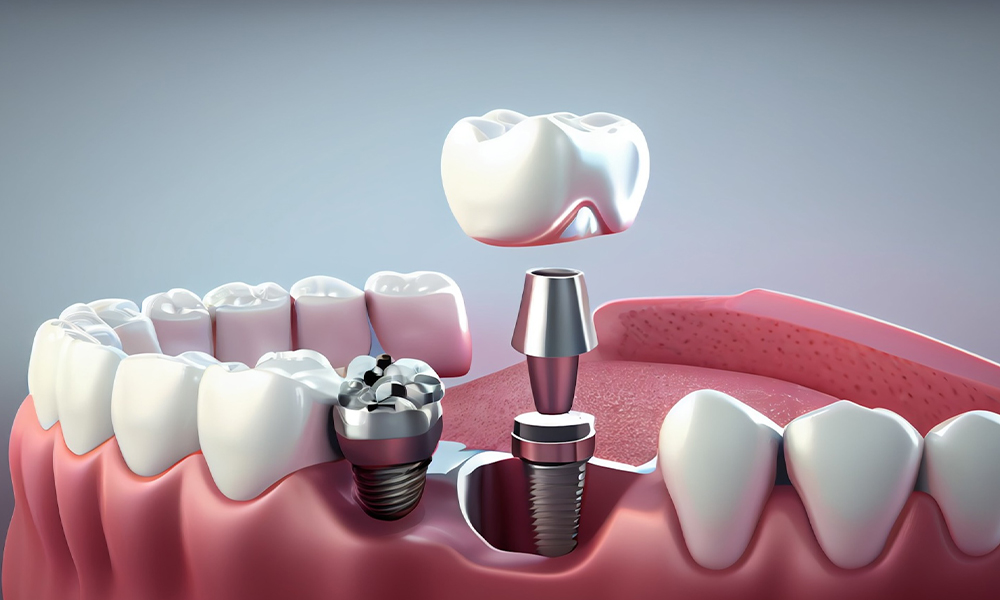 Implantaatbehandeling