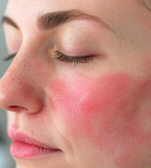 Behandeling Van Couperose en Rosacea